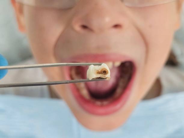 Best Dentist for Tooth Abscess  in Daphne, AL